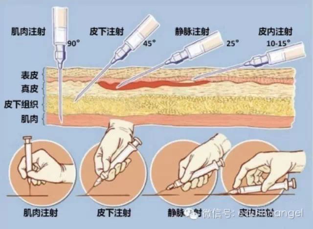 各种注射法的进针角度