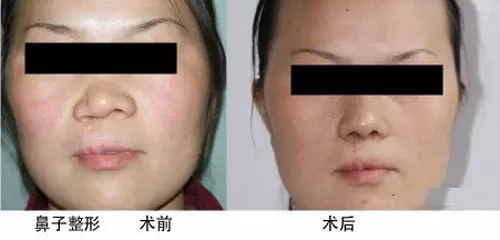 隆鼻失敗了，該如何修復(fù)？