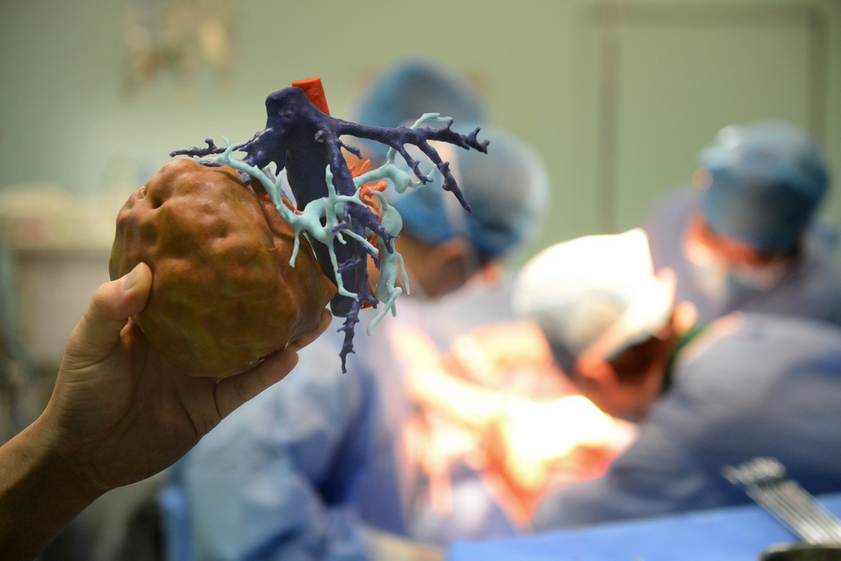 国内首例3d打印指导腔镜下复杂肝脏肿瘤切除术成功实施