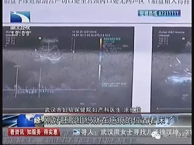 怀二胎时“刀疤”撑不住 武汉准妈妈无奈流产 《经视直播》-怀孕期