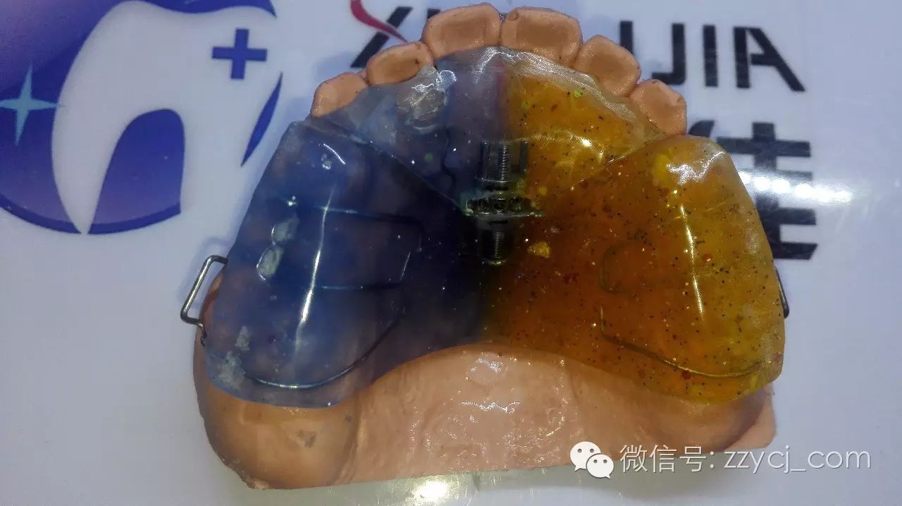 5,前牙反合解除后应分次磨除后牙合垫,每次磨去0.3-0.