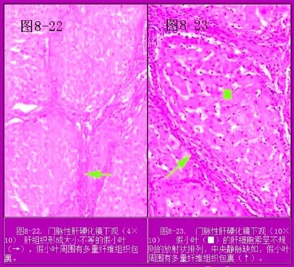 (2)肝硬化时由于纤维组织收缩,肝脏体积一般是缩小的: 对于病毒性