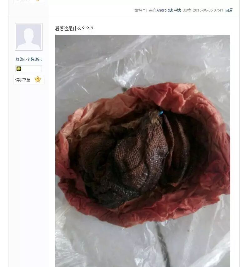 济宁人民医院东院区三甲医院竟把纱布遗留患者腹中