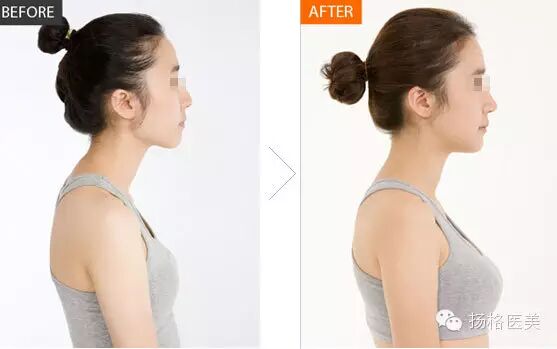 【拨点谜团】隆胸后还能不能正常怀孕、母乳喂养?-怀孕期