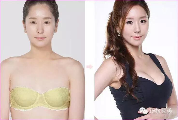 【拨点谜团】隆胸后还能不能正常怀孕、母乳喂养?-怀孕期