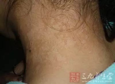 夏季防汗斑 两种方法让你皮肤焕然一新