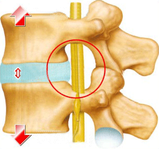 腰椎间盘突出康复锻炼和预防方法(图2)