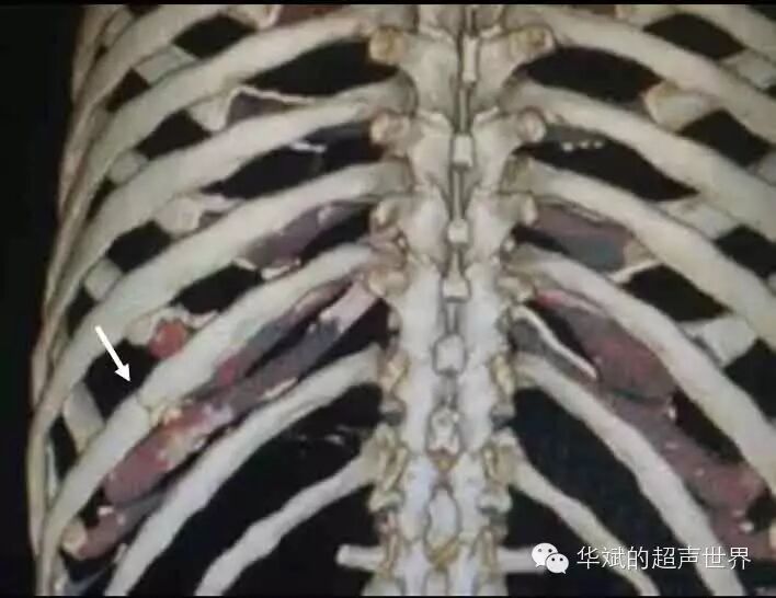 超声检查可以作为肋骨骨折的首选影像学方法