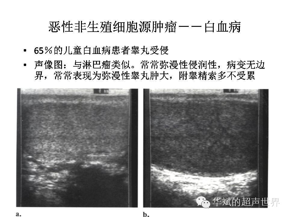 [转载]阴囊包块