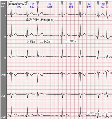 实例2:     心电图特征:本图提前出现的qrs-t波群前后均无p波