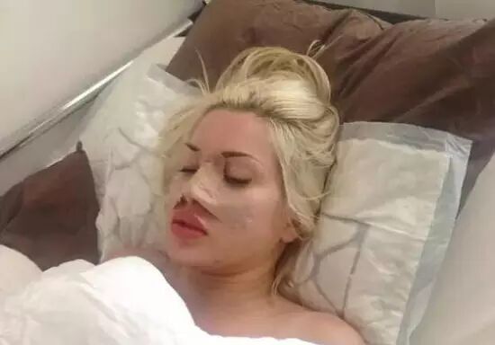 变态的美——美女为瘦腰锯掉6根肋骨！