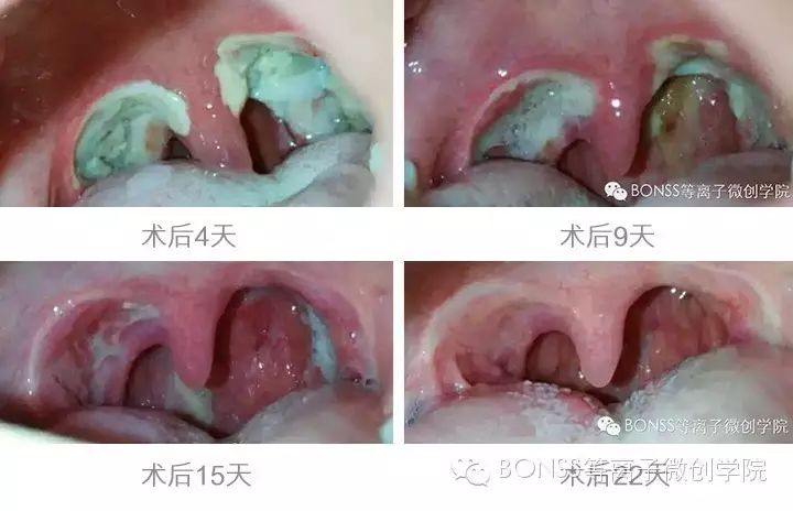 【专家解密】关于射频等离子体扁桃体术后你不知道的那些事