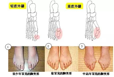 使用绷带或矫正器,必须使拇指可以分开,并训练脚趾力量,减少压迫.