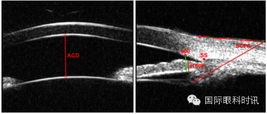 上图为前部巩膜嵌入巩膜突.中图为睫状突前旋,睫状沟消失.