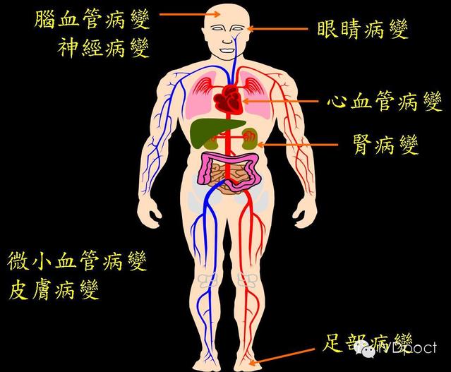 2型糖尿病是氧化还原性疾病