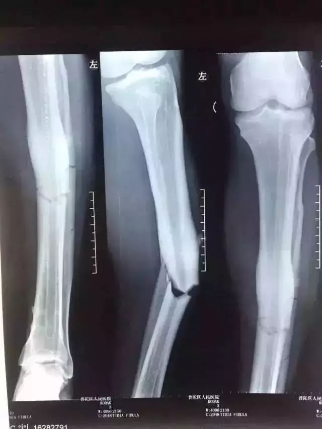 入院后拍摄的左小腿x线片显示 左胫腓骨中段粉碎性骨折