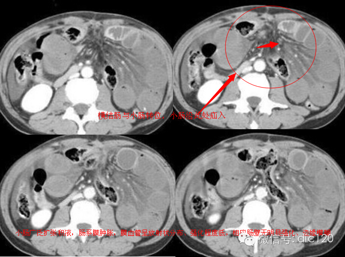经典“胃溃疡术后横<font color="red">结肠系膜</font>破裂、小肠内疝”一例