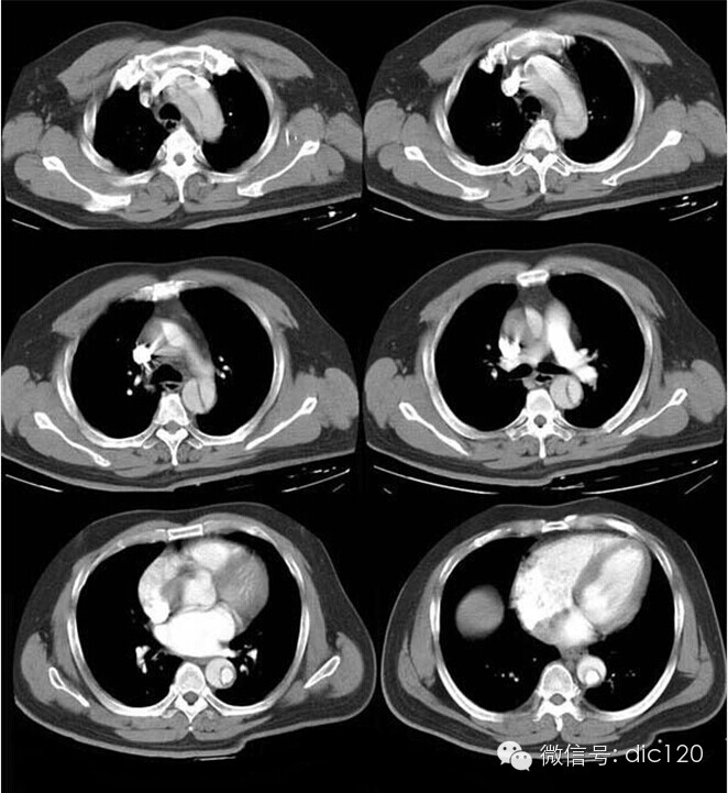 胸主动脉夹层动脉瘤（DeBakey Ⅰ型）