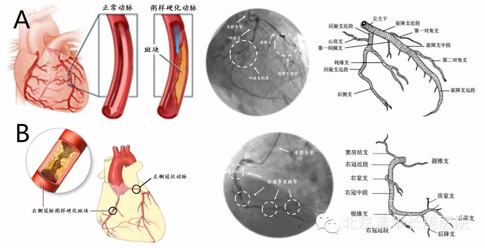 患者冠脉造影.