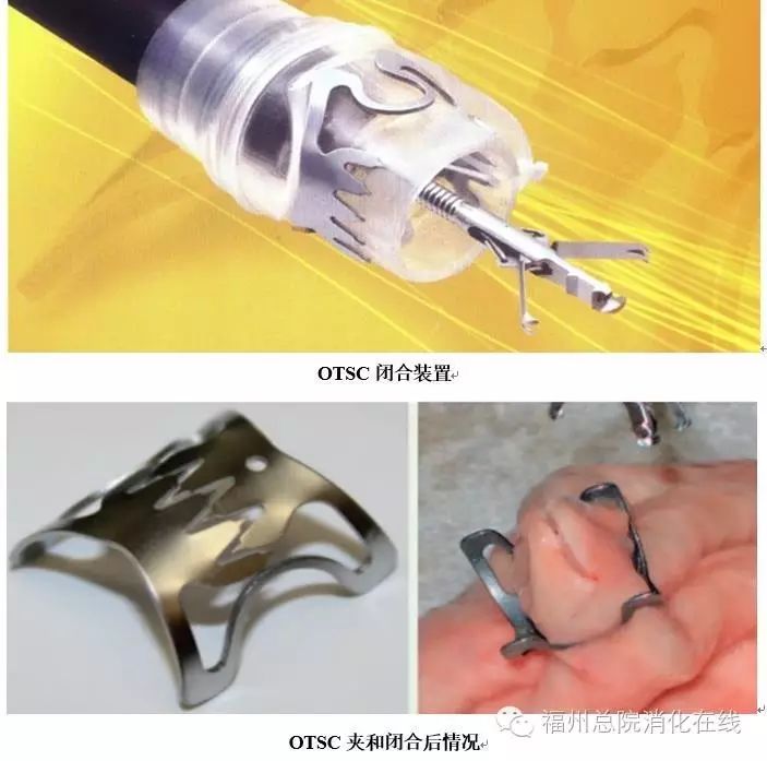 6,大出血及消化道穿孔:应用金属夹缝合器(otsc)等新型内镜下止血器械.