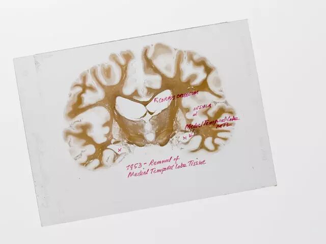 莫莱森大脑的切片