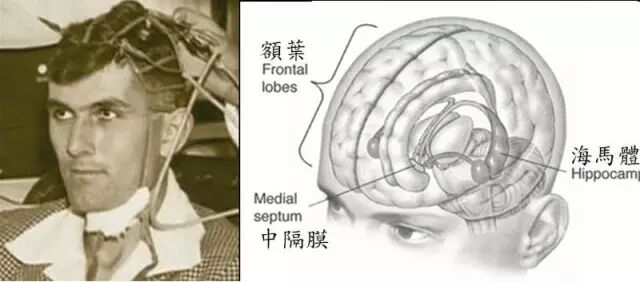 癫痫治好了,记忆也不见了