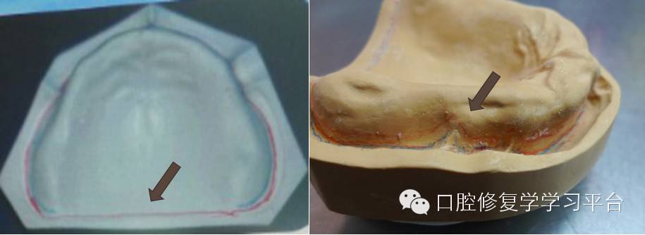 填倒凹:上颌前庭区,下颌舌侧翼缘区,菲薄的牙槽嵴,可能会影响托盘
