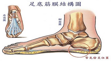 足底筋膜炎的康复训练方法-第1张图片-体能网
