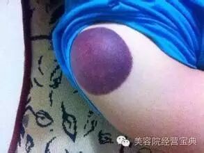 拔罐的专业知识！