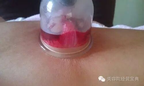 拔罐的专业知识！
