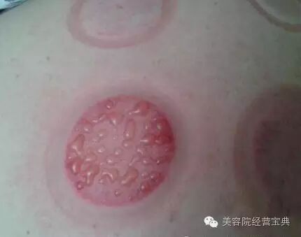 拔罐的专业知识！