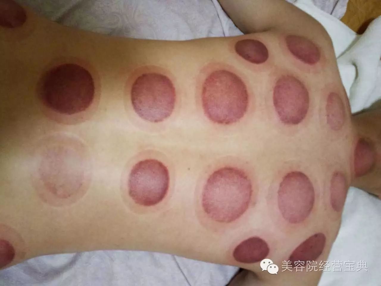 拔罐的专业知识！