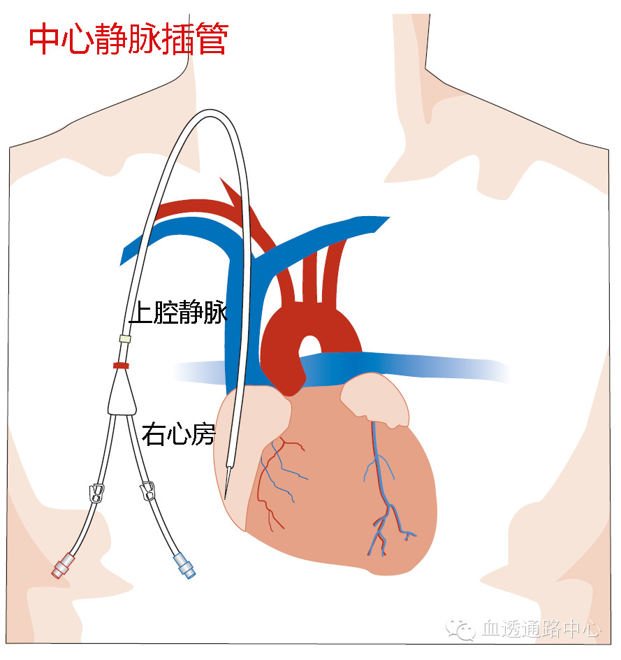 人工血管动静脉瘘是血透通路中的第二选择.