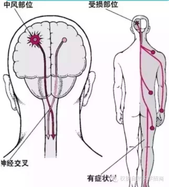 脑梗,心梗的先兆和预防!非常有价值