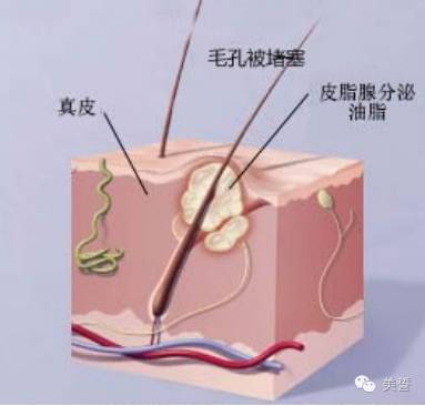 当皮脂腺分泌旺盛,皮脂无法顺利排出堵塞毛囊,进而产生炎症.