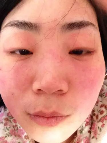 什么是干敏？什么是油敏？什么是激素敏？？