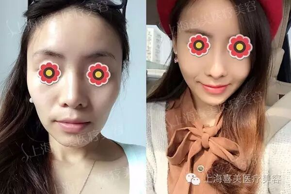 孟瑶脂肪填充苹果肌、面颊术后2个月