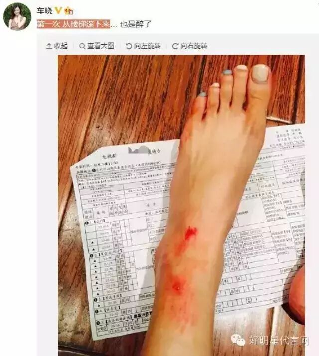 车晓从楼梯滚下摔伤 膝盖包扎脚部血迹斑斑
