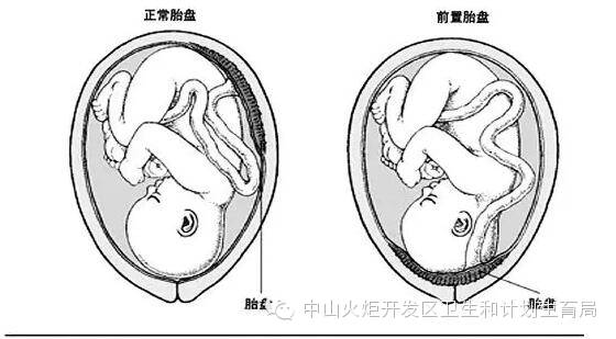 【中医院案例】备战二胎,有剖宫产史的妈妈要提防胎盘前置!-怀孕期