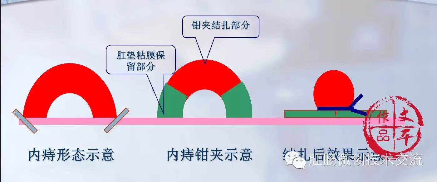 外痔剔除标准)和内括约肌以及各层间隙(内括约肌和内痔间的潜在间隙是