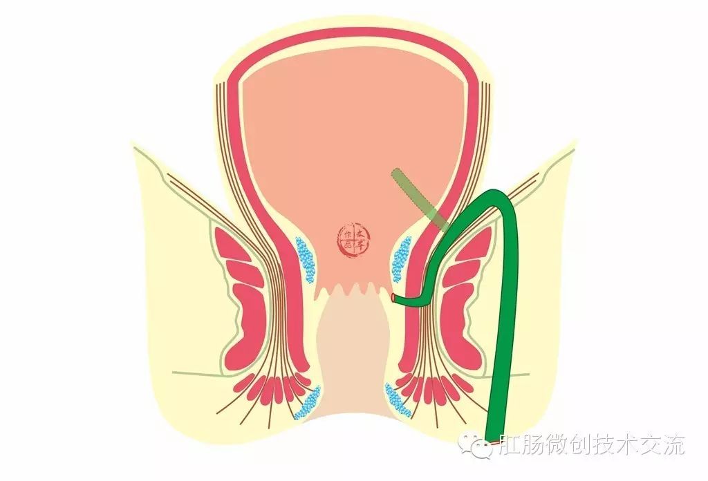 【手术分享】一例复杂括约肌上肛瘘切除挂线术