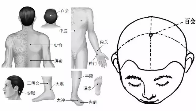 湖南針灸理療培訓(xùn)班失眠按摩療法