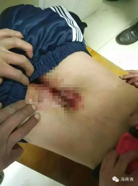 一小学老师体罚8岁男童！把娃下面打成了这模样！！转 <wbr>死 <wbr>她！！