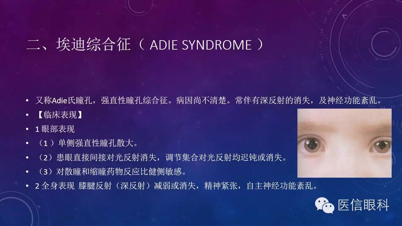 adie瞳孔与阿罗瞳孔相反,表现为一侧瞳孔散大,多发生于30岁以下的