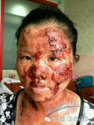 (图片 权健火疗 肿瘤医院 )