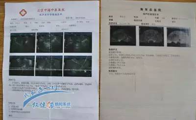 病例1002:多发性子宫肌瘤,宫颈囊肿——权健洁净宝加火疗,2个半月治愈