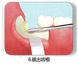 拔牙流程图，你们不懂这种痛！864 / 作者:火星娃崽 / 帖子ID:113290