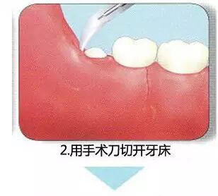 拔牙流程图，你们不懂这种痛！323 / 作者:火星娃崽 / 帖子ID:113290