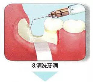 拔牙流程图，你们不懂这种痛！329 / 作者:火星娃崽 / 帖子ID:113290