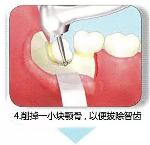 拔牙流程图，你们不懂这种痛！557 / 作者:火星娃崽 / 帖子ID:113290